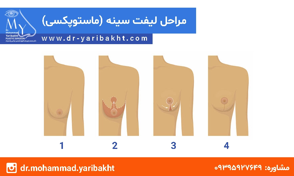 مراحل ماستوپکسی در اصفهان