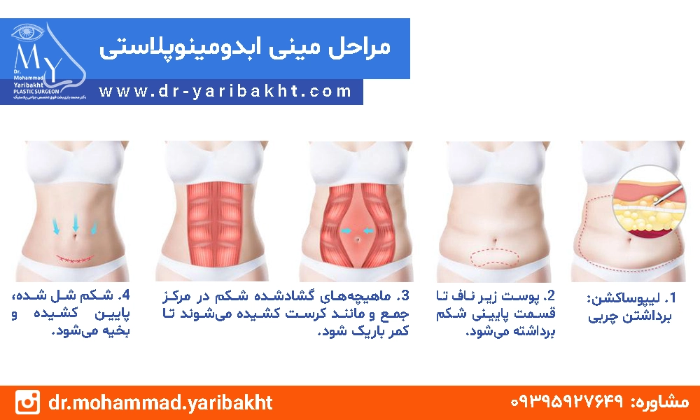 مراحل مینی ابدومینوپلاستی در اصفهان