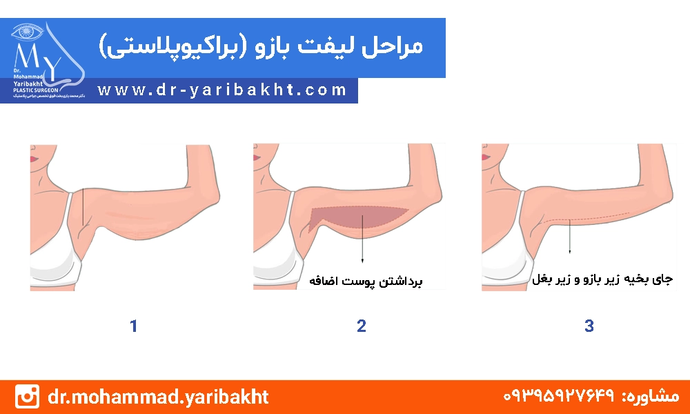 لیفت بازو در اصفهان