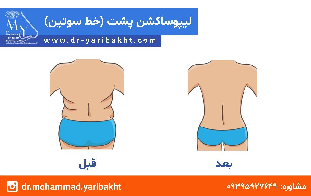 لیپوساکشن پشت در اصفهان