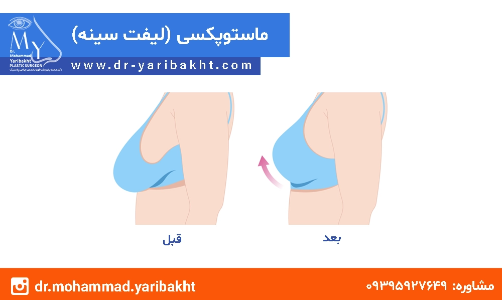 جراحی لیفت سینه در اصفهان