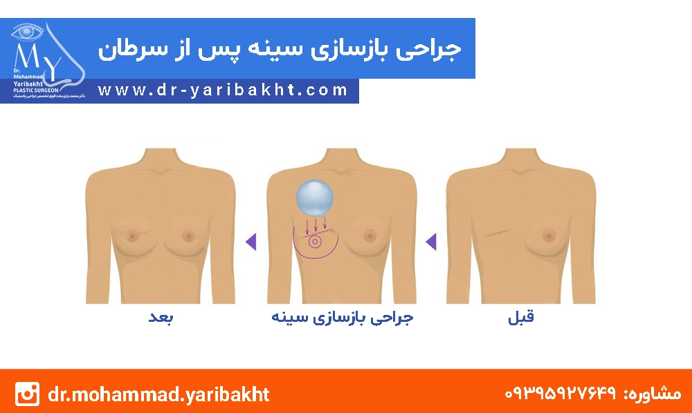 بازسازی سینه بعد از سرطان