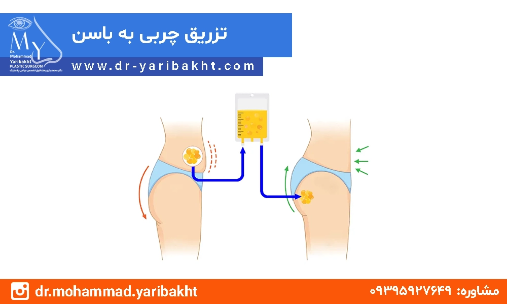 تزریق چربی به باسن در اصفهان