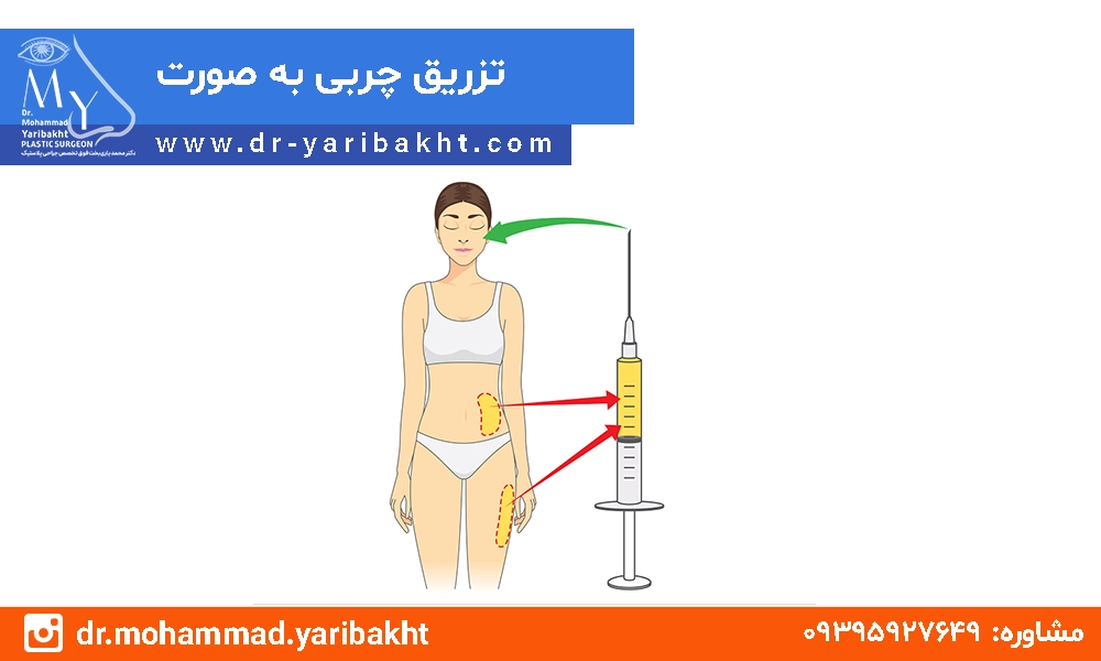 تزریق چربی به صورت در اصفهان