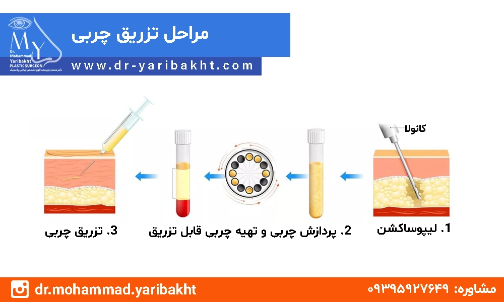 تزریق چربی در اصفهان