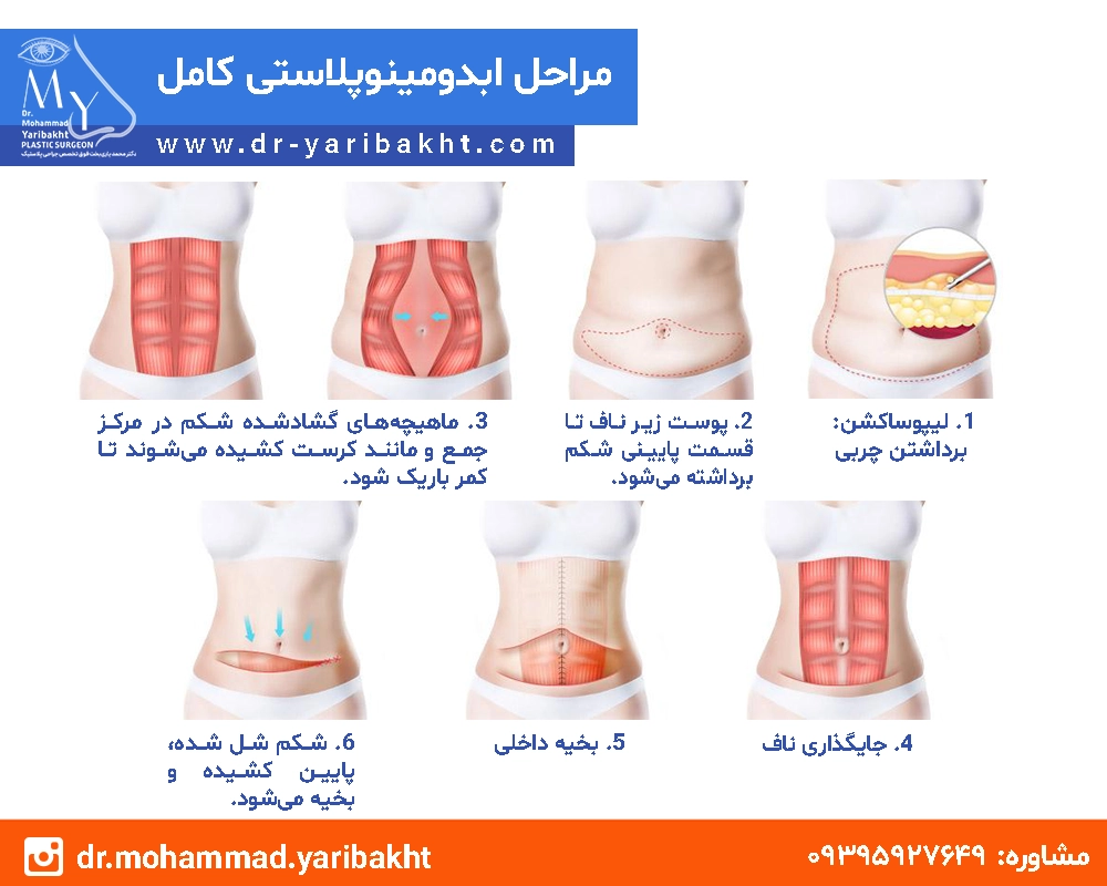 ابدومینوپلاستی در اصفهان 