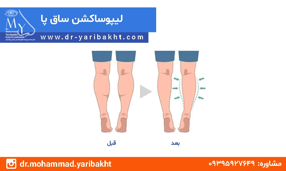 لیپوساکشن ساق پا در اصفهان