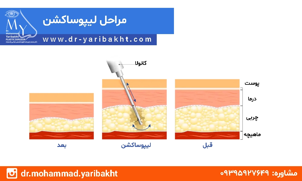 مراحل لیپوساکشن در اصفهان