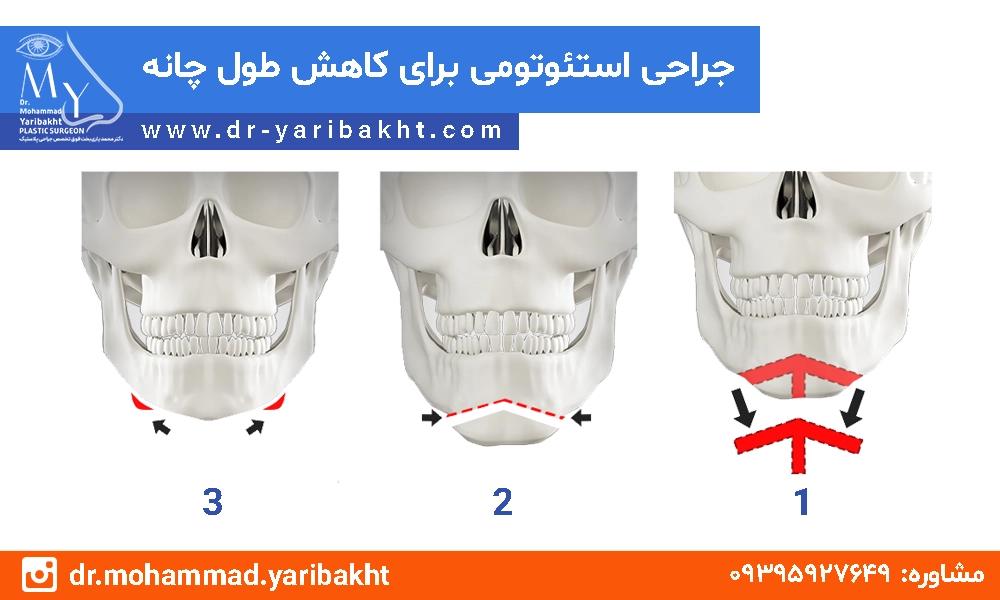 جراحی استئوتومی در اصفهان برای کاهش طول چانه