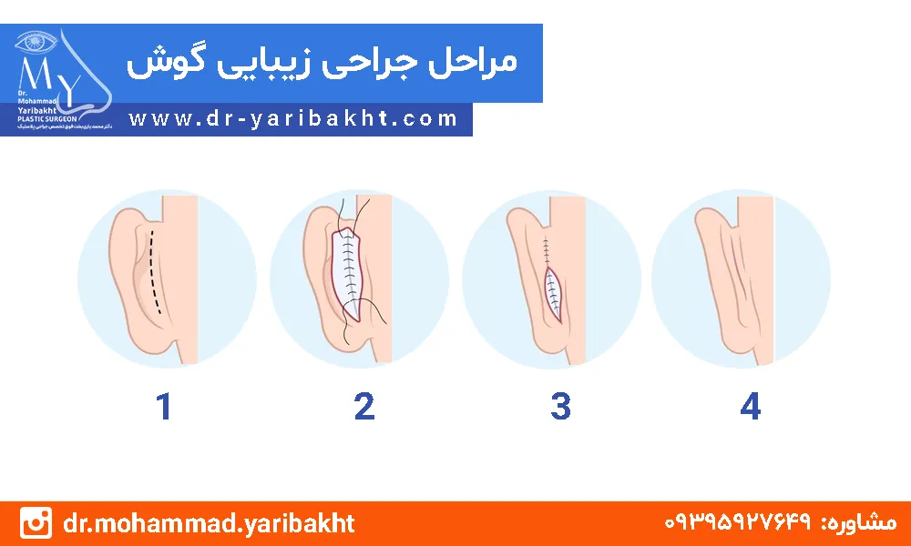 اتوپلاستی در اصفهان