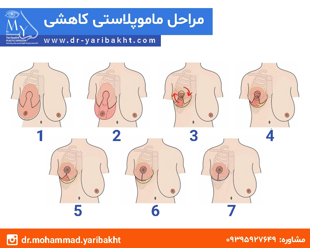 جراحی ماموپلاستی در اصفهان