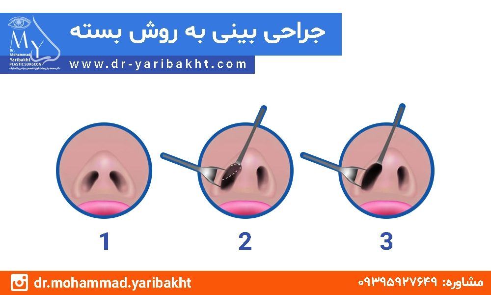 عمل جراحی بینی اصفهان به روش بسته