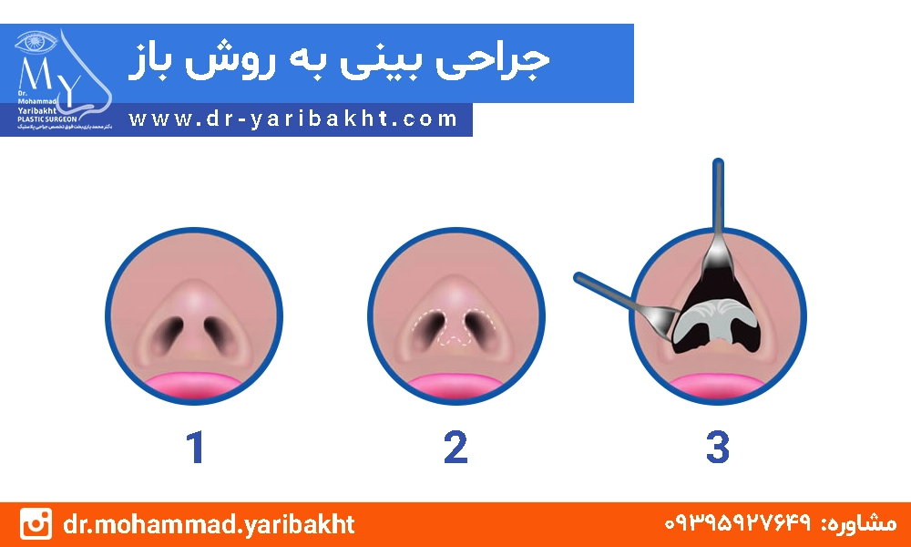 رینوپلاستی به روش باز