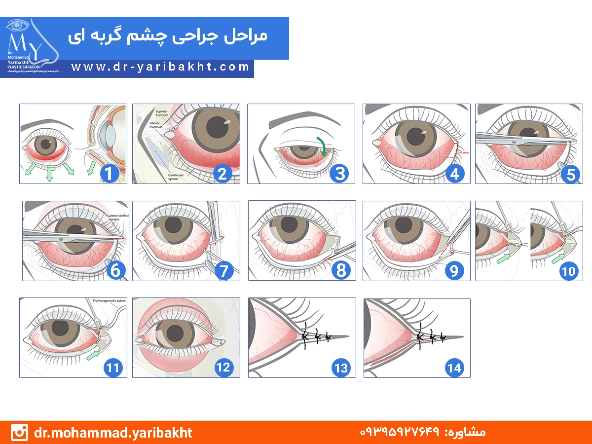 جراحی چشم گربه ای در اصفهان