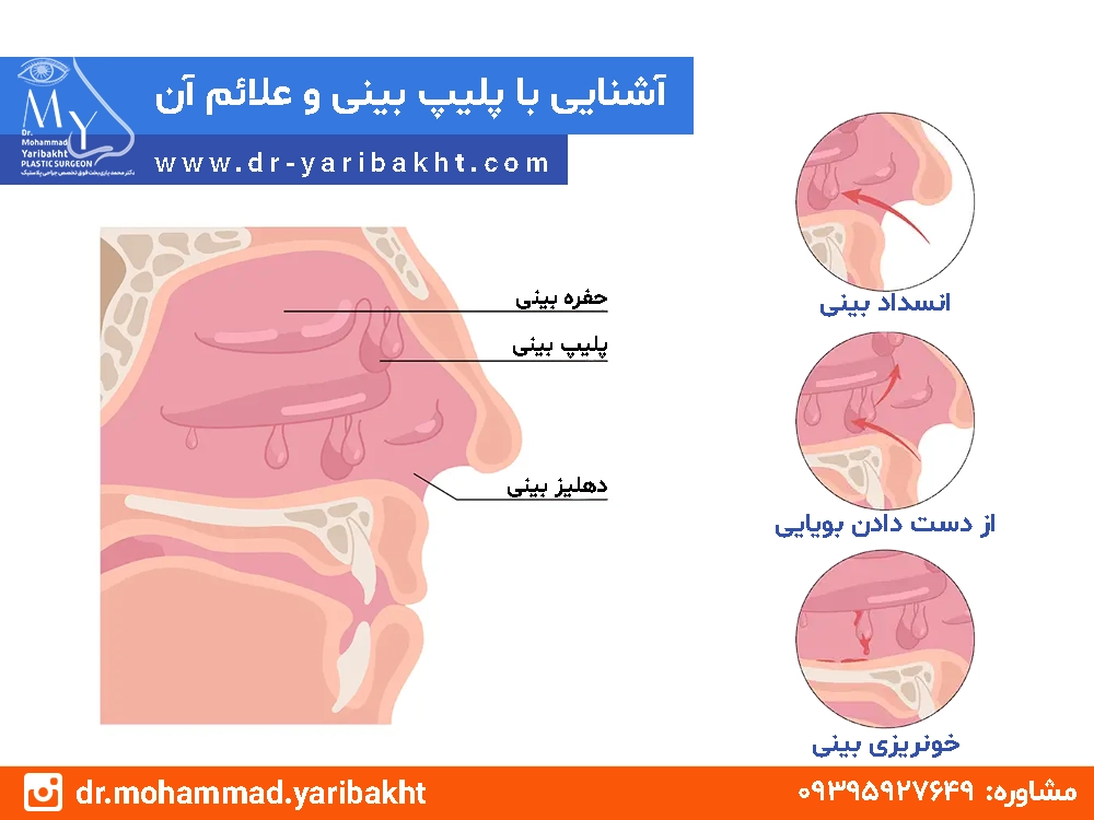 پلیپ بینی چیست