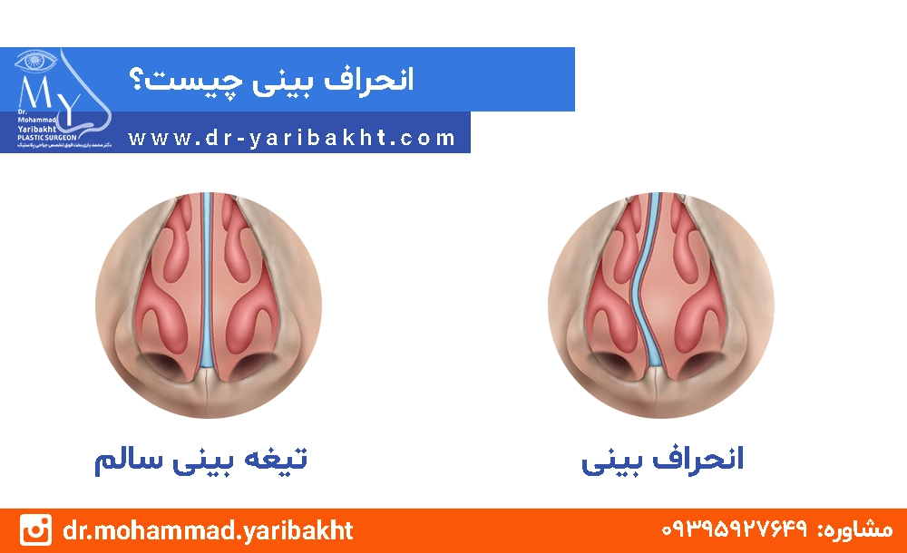 سپتوم چیست؟