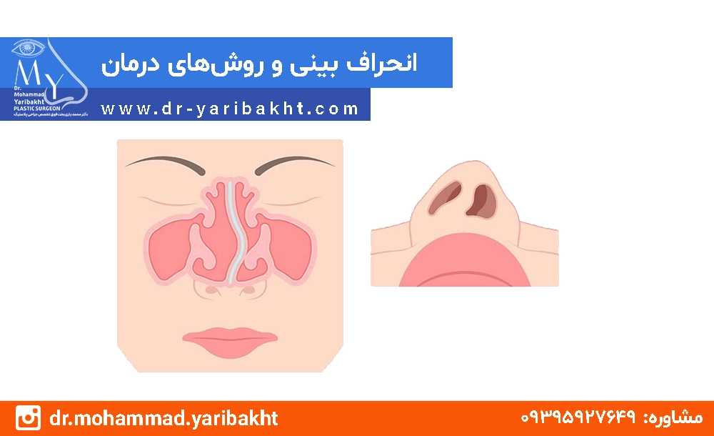 جراحی انحراف بینی