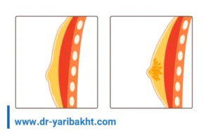 فرق ژنیکوماستی با چربی