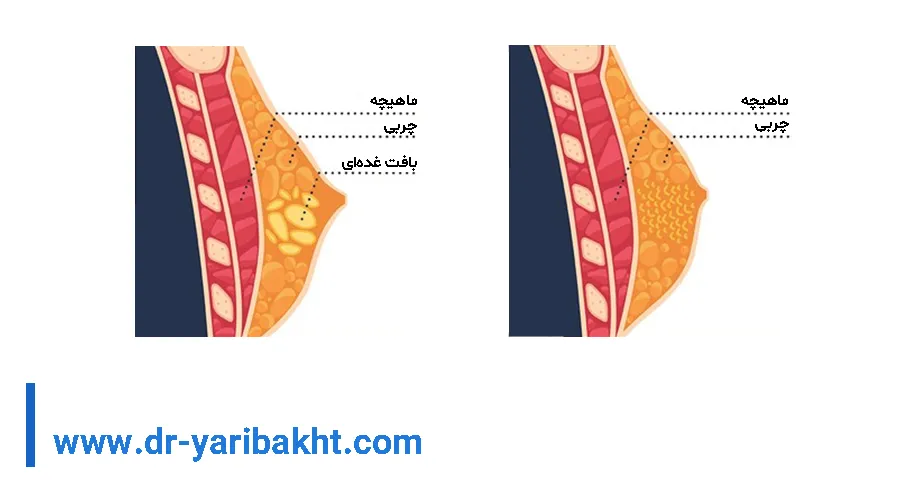 فرق ژنیکوماستی با چربی