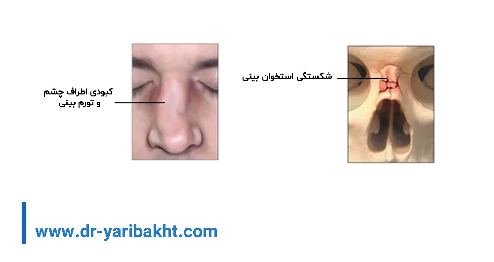 علائم شکستگی بینی