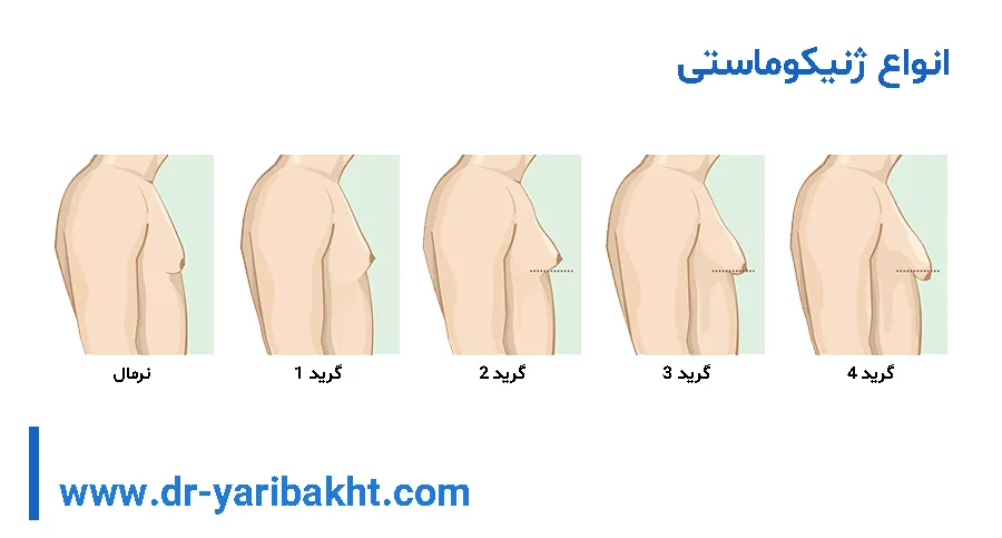 ژنیکوماستی یک طرفه
