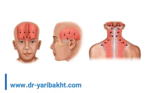 بوتاکس برای میگرن