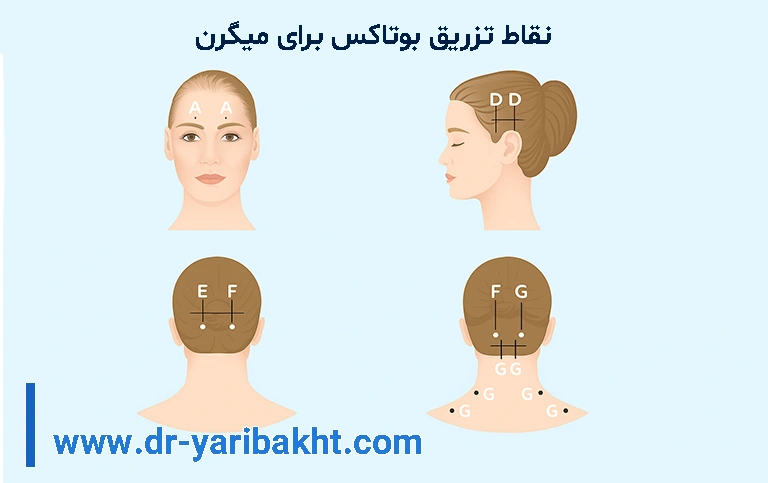 نقاط بوتاکس میگرن